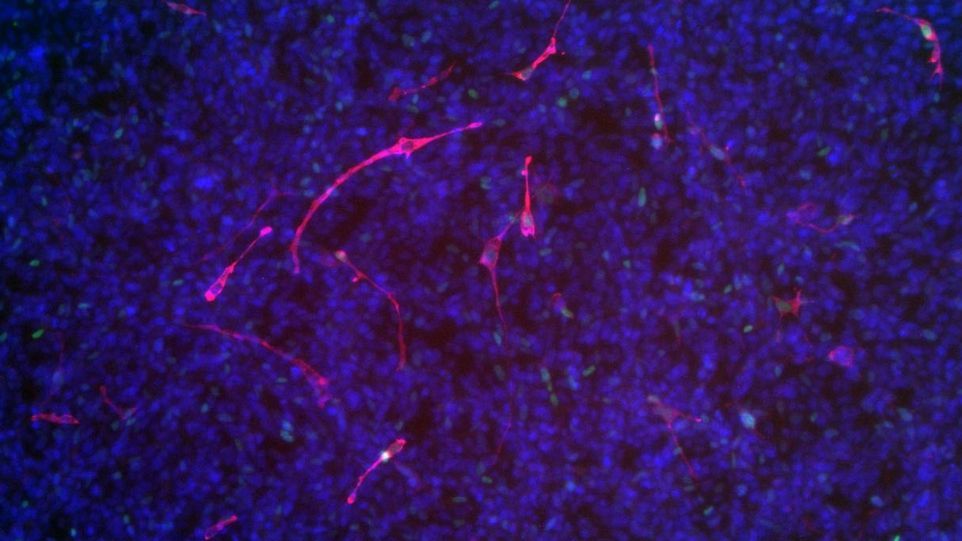 Induction of myogenic differentiation and reduction of cell division in rhabdomyosarcoma cells after reduction of the amount of TRPS1 using siRNA. Blue and red cell structures