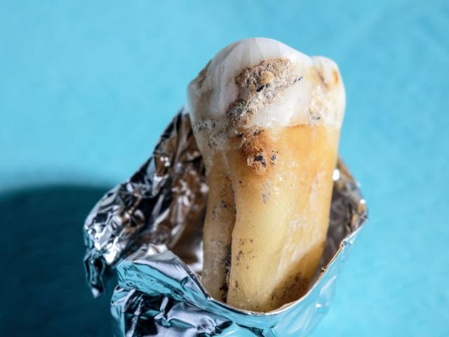 Tooth with dental calculus